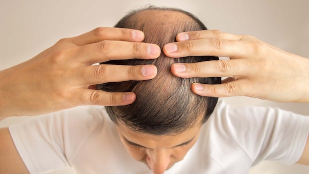 Hair loss drug finasteride can trigger debilitating aspect-effects, males insist