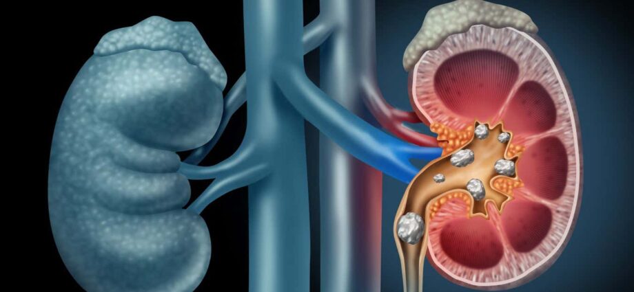 Magnetic gel can also steal away kidney stones more effectively