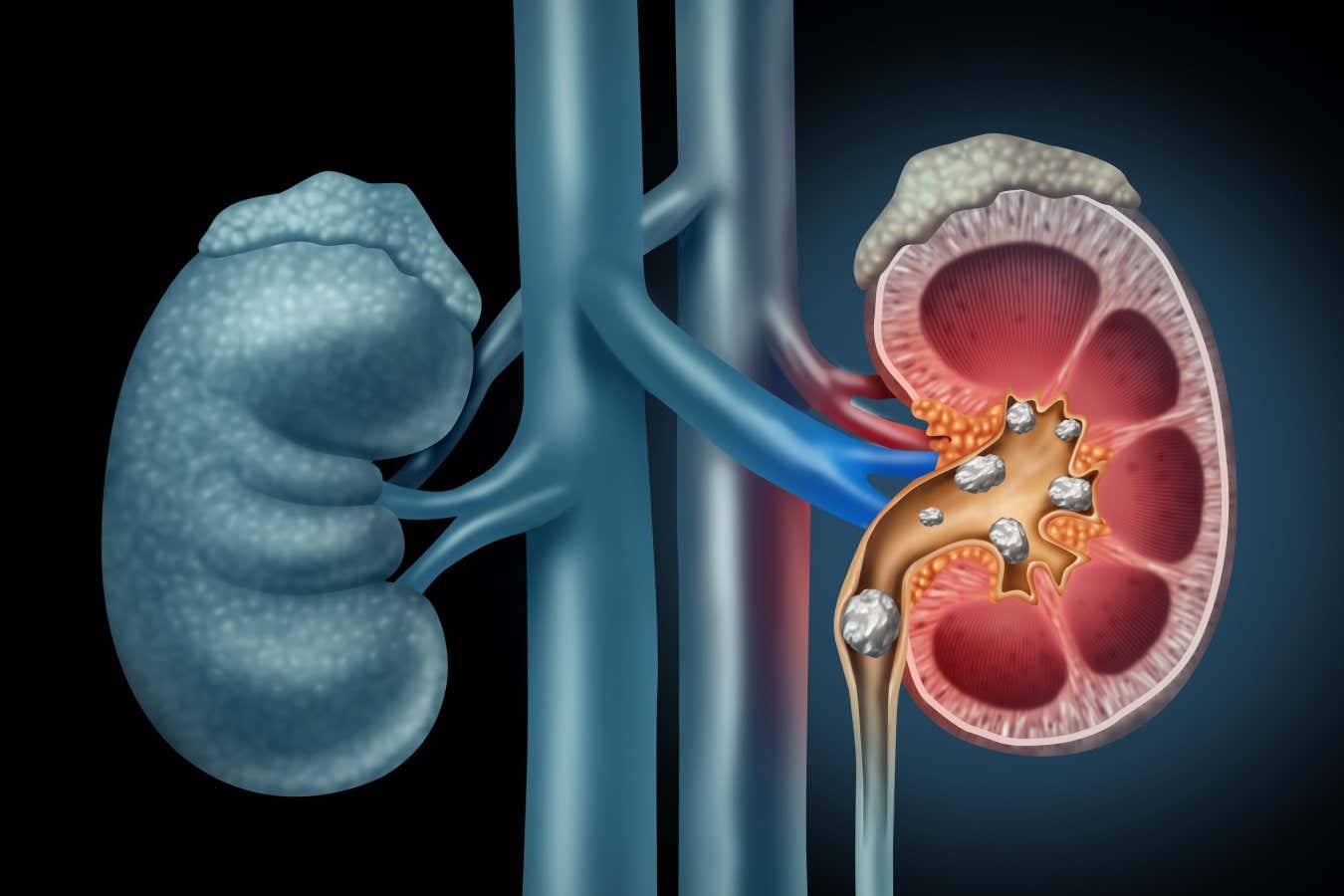 Magnetic gel can also steal away kidney stones more effectively